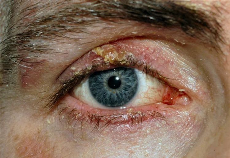 kanker kulit di sekitar kelopak mata